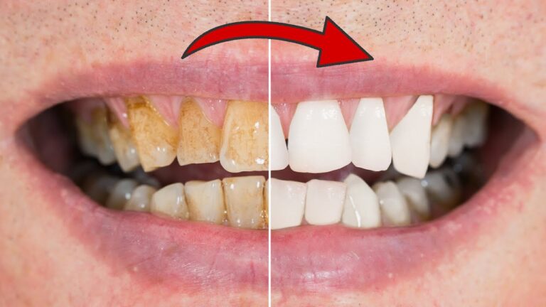 Sbianca i tuoi denti in 2 minuti: scopri il trucco efficace per un sorriso brillante!