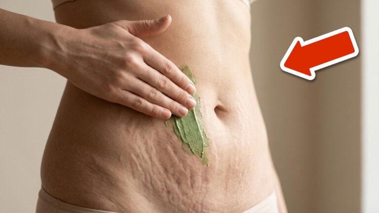 Scopri 5 metodi veloci per eliminare le smagliature in modo efficace!