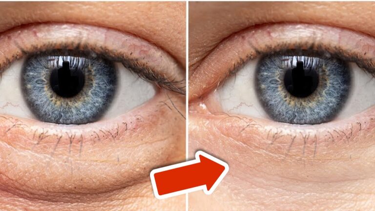 Rimuovi le occhiaie in 20 minuti con questo semplice trucco naturale!