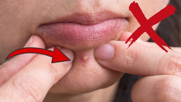 10 luoghi pericolosi dove evitare di schiacciare i brufoli! Scopri perché!